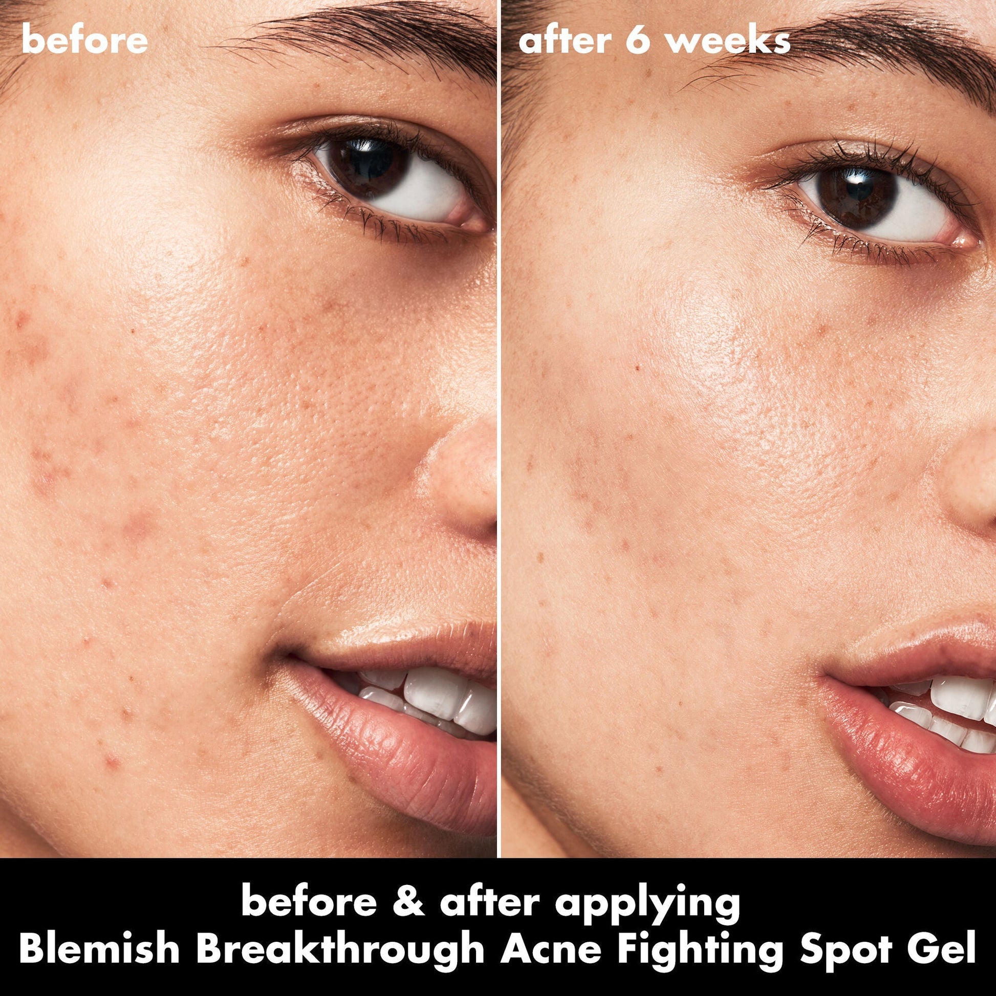 blemish-breakthrough-acne-fighting-spot-gel-n9 0326_EDU_BB_SpotGel_BA_ISABELLA.jpg