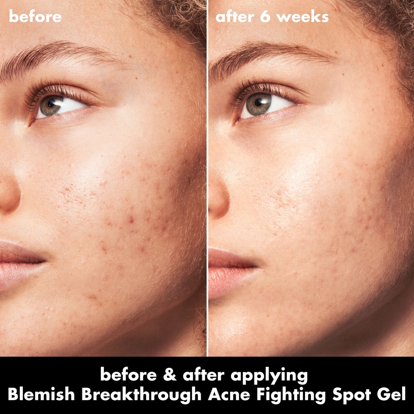 blemish-breakthrough-acne-fighting-spot-gel-n9 0326_EDU_BB_SpotGel_BA_MARLEY.jpg