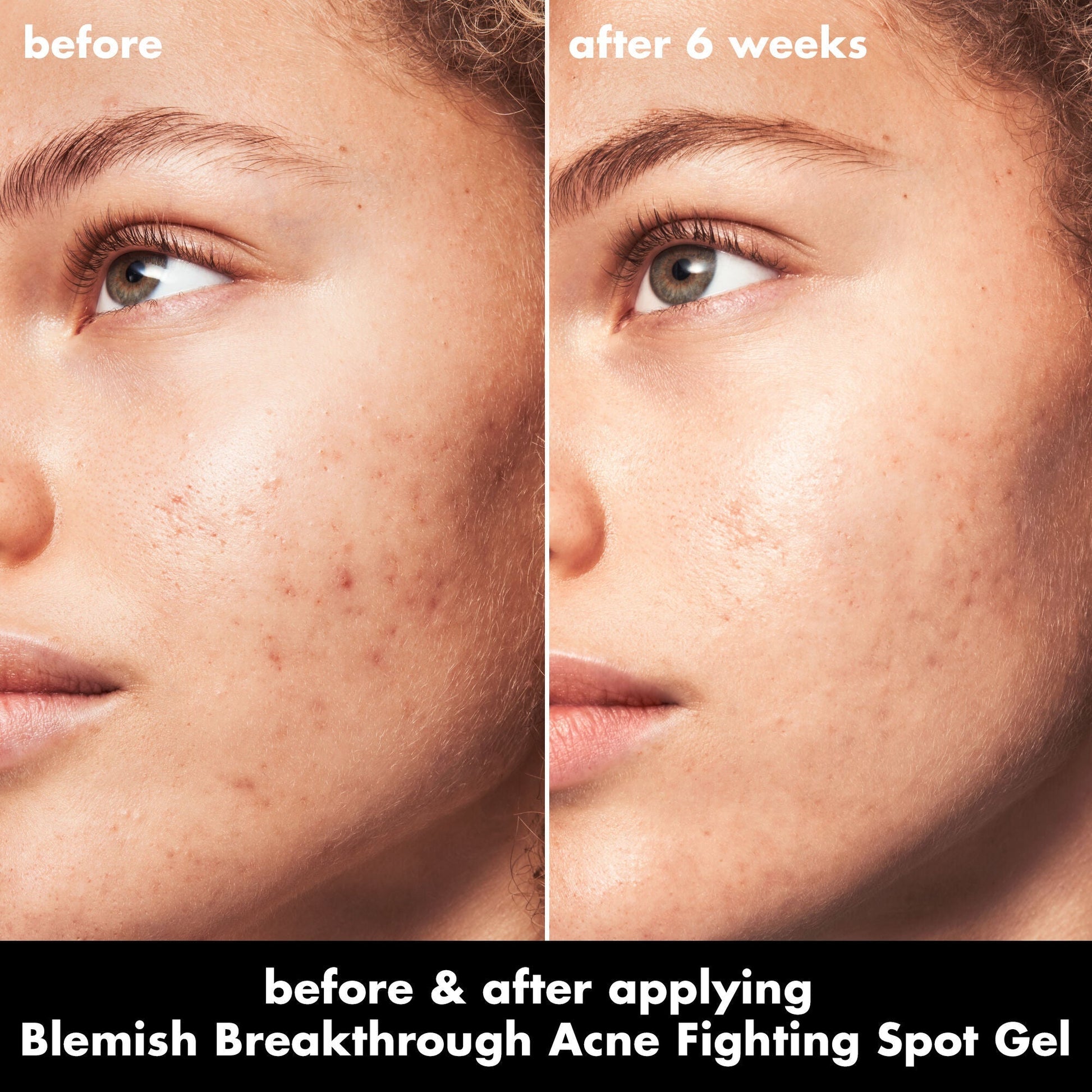 blemish-breakthrough-acne-fighting-spot-gel-n9 0326_EDU_BB_SpotGel_BA_MARLEY.jpg