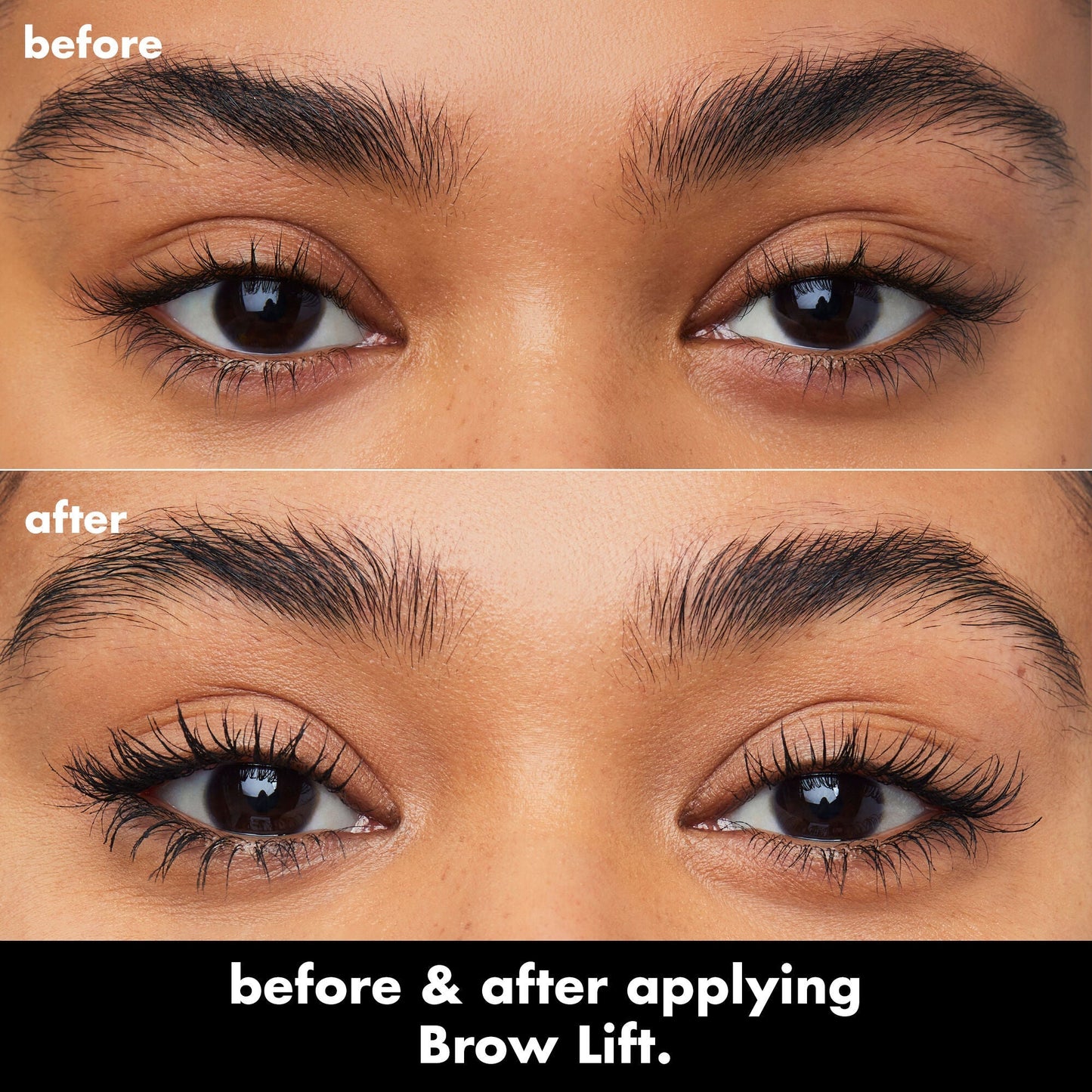brow-lift-q6 0326_EDU_BrowLift_BA.jpg