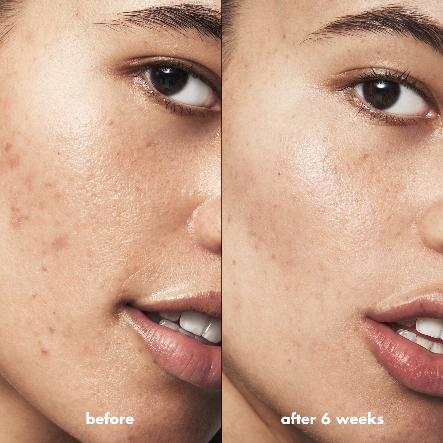 blemish-breakthrough-acne-clarifying-cleanser-d3 Acne_PDP_Isabella_Before_After_a3ff322b-cc6f-4b1a-9db3-bfb66c15d034.jpg