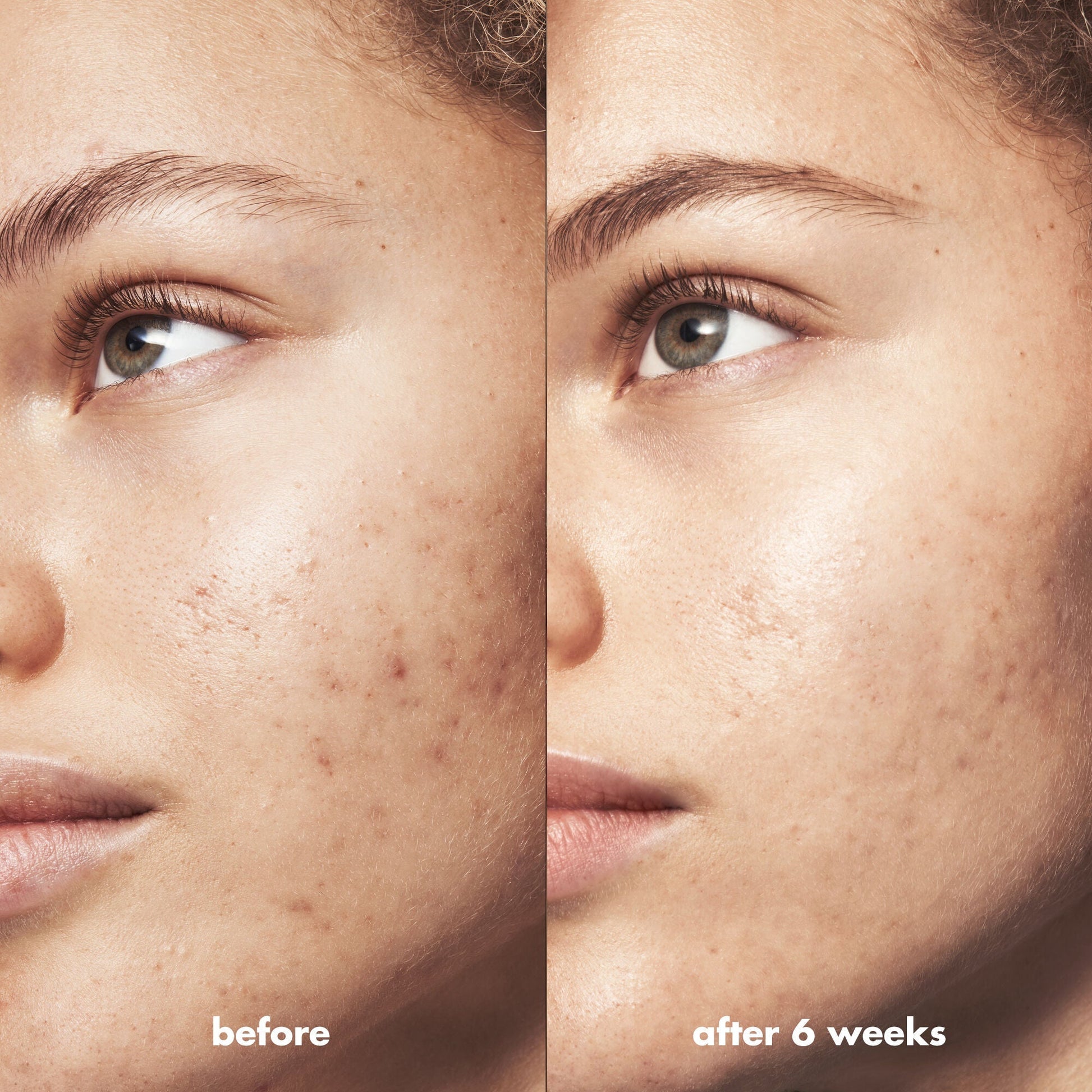 blemish-breakthrough-triple-acid-resurfacing-serum-a7 Acne_PDP_Marley_Before_After_1a95cac5-0af6-43b6-a936-d0bacbdec0bf.jpg